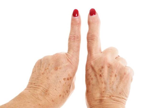 Deformarea osteoartritei pe degete