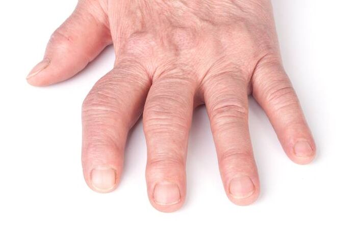deformarea osteoartritei pe mâini