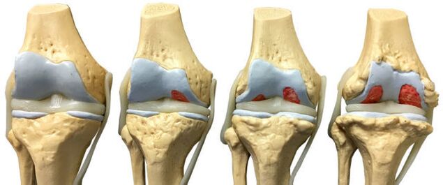 Afectarea articulațiilor în diferite etape ale dezvoltării artrozei gleznei