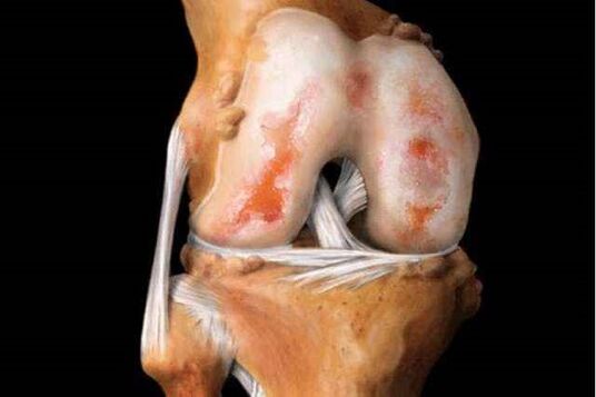 Deteriorarea articulației genunchiului cu osteoartrita