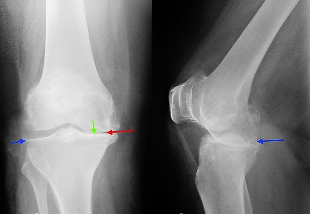 Imagine cu raze X a osteoartritei articulației genunchiului