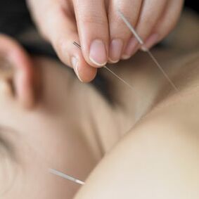 acupunctură