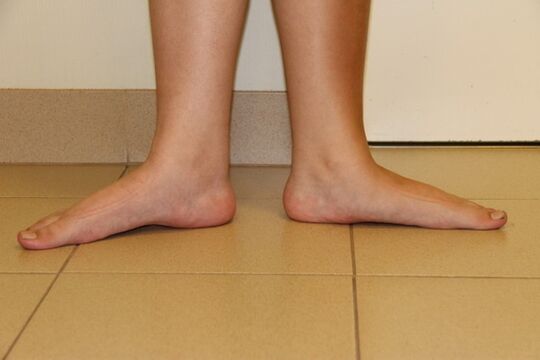 Uneori, picioarele plane sunt cauza osteoartritei gâtului