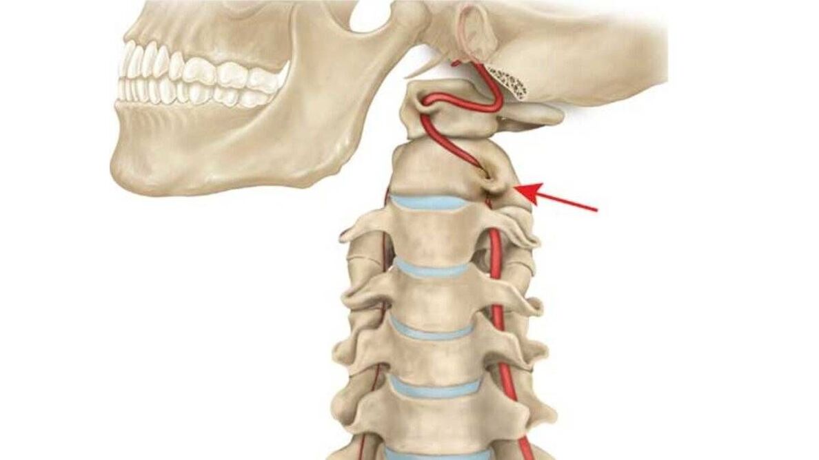 Osteocondroza coloanei cervicale