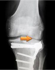 Osteoartrita articulației genunchiului