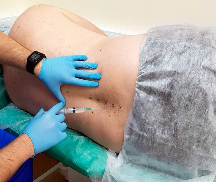 Blocaje medicale pentru spate