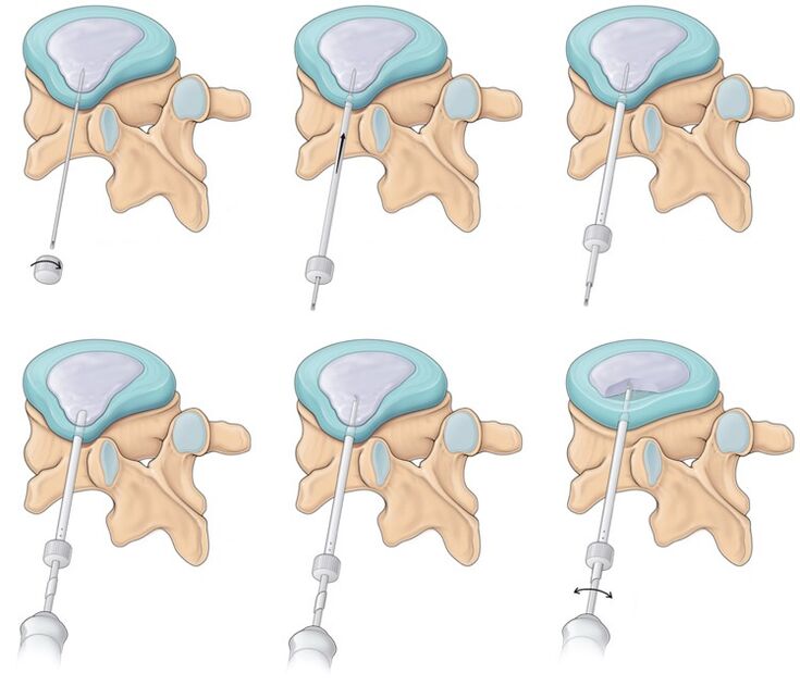 Chirurgie pentru dureri de spate