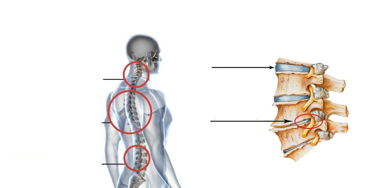Osteocondroza coloanei vertebrale