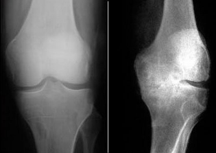 Metode de diagnostic osteoartrita