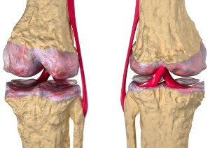 Osteoartrita genunchiului