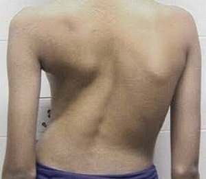 Scolioza ca cauză a durerilor de spate