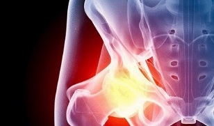 Cauzele dezvoltării artrozei șoldului