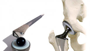 Endoprotezarea articulației șoldului în osteoartrita