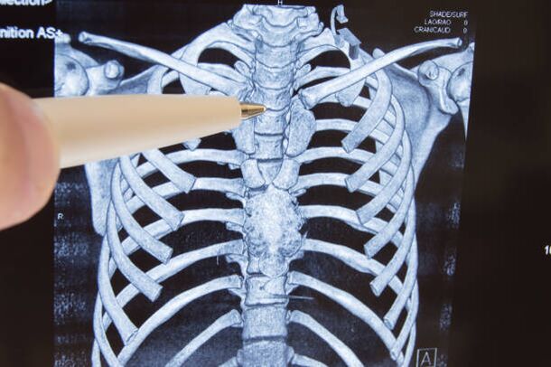 Osteocondroza este o boală a coloanei vertebrale