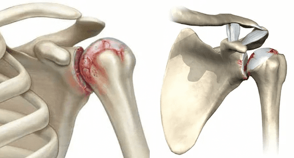 Cum arată osteoartrita articulației umărului 