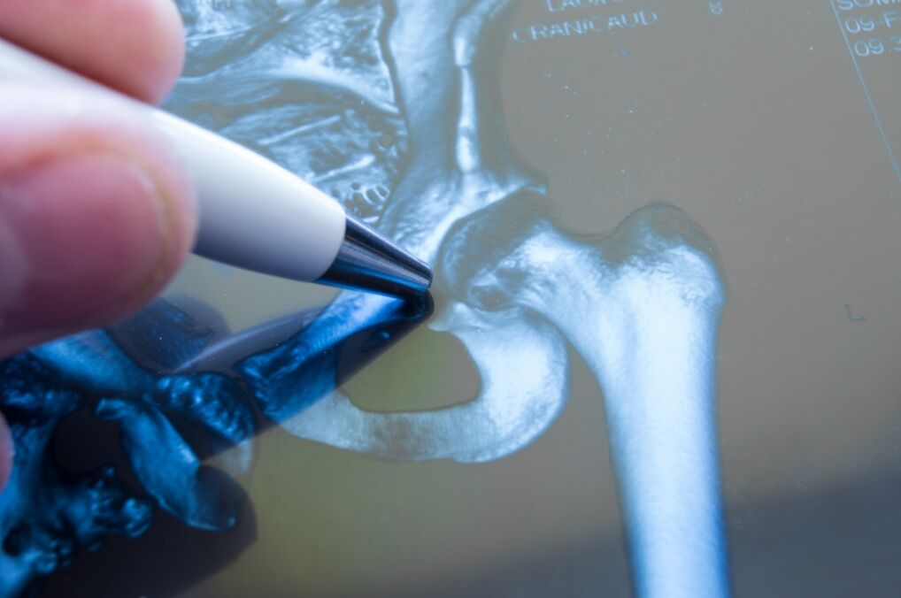 Artroza articulației șoldului pe radiografie