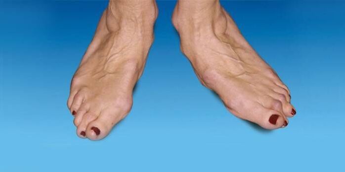Malpoziția piciorului în artroza gleznei
