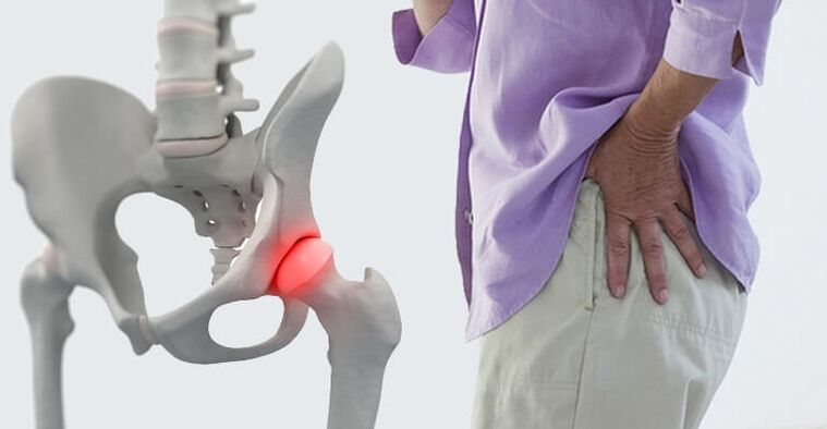 Durerea de șold - un simptom al osteoartritei articulației șoldului