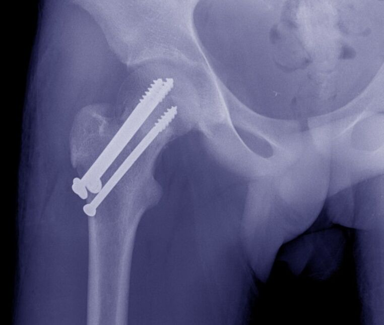 Radiografia articulației șoldului, osteosinteza fracturii cu fixatori interni